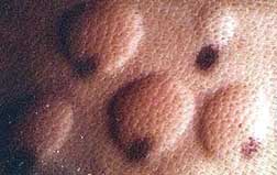 Bumps in skin caused by a positive reaction to the allergen