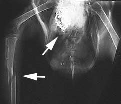 X-ray with arrows pointing to lead in gizzard and fracture in the bone of a bird