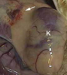 Picture Taken During Surgery of Inflamed Adrenal Gland Buried in Fat