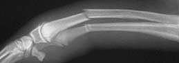 X-Ray of fractured radius and ulna