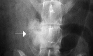 X-ray of spinal bone tumor with arrow pointing to the tumor