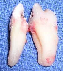 Cracked Tooth After Removal