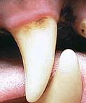 Stage 1 Dental Disease