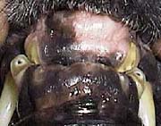 Incisors Worn Down to the Gums