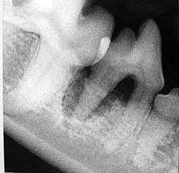 Dental X-ray of Problem Tooth
