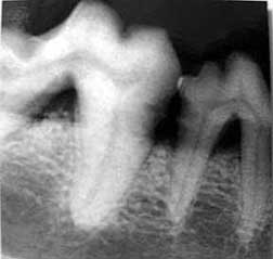 Dental X-ray of Diseased Jaw