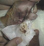 Wiping ear discharge with gauze