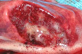 Lung tissue filled with frothy fluid