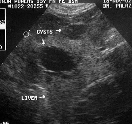 Why should you have a liver ultrasound?