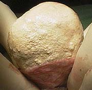 The bladder stone almost completely removed from the urinary bladder