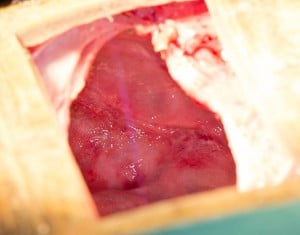 Inflamed lining of the urinary bladder with no stone fragments