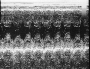 Ultrasound Picture Of The Thickness Of The Cardiac Muscle Wall