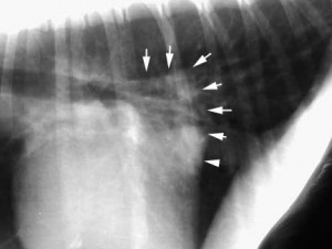 Xray Of Enlarged Left Atrium