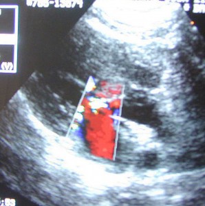 Visualizing Blood Flowing Through The Heart Chambers