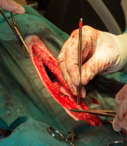 Suturing long incision