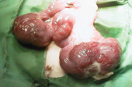 Cancerous uterus at surgery