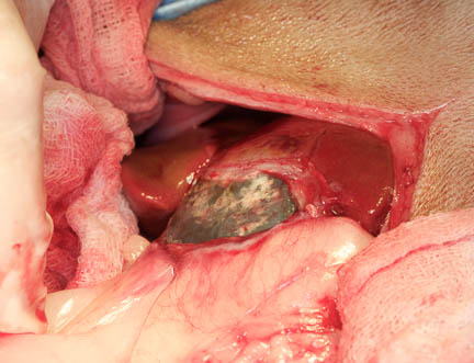 Surgeon finding the gallbladder