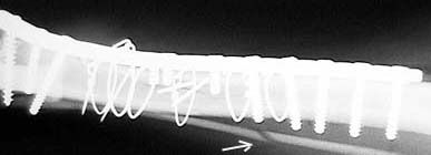 Post op radiograph showing plate, screws, and wires