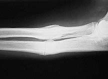 X-Ray of healed radius and ulna