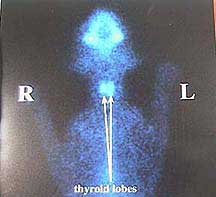 Picture or radioactive iodine scan