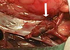 A clot in artery to the rear legs