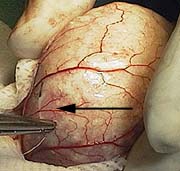 Putting a stay suture in the thin walled urinary bladder
