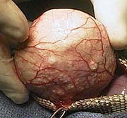 Urinary bladder with stone inside of it