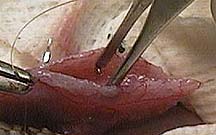 Suturing the bladder closed after stone removal