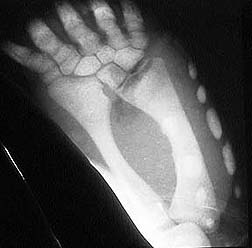 X-ray of foot of a CDT