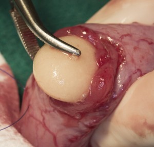 Stone Being Removed From A Urinary Bladder