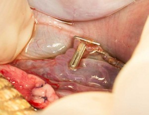 IggieOVH-hemoclip5 All hemoclips placed and ovary removed