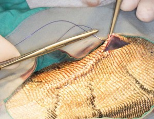 Avoiding the central vein when suturing the skin edges