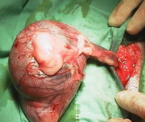 Surgery-TesticleTumor