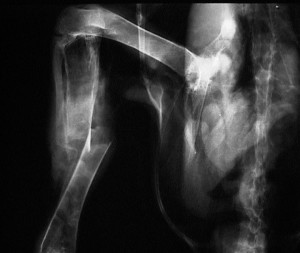 X-ray of a pelican with a fracture shin (tibiotarsus) bone
