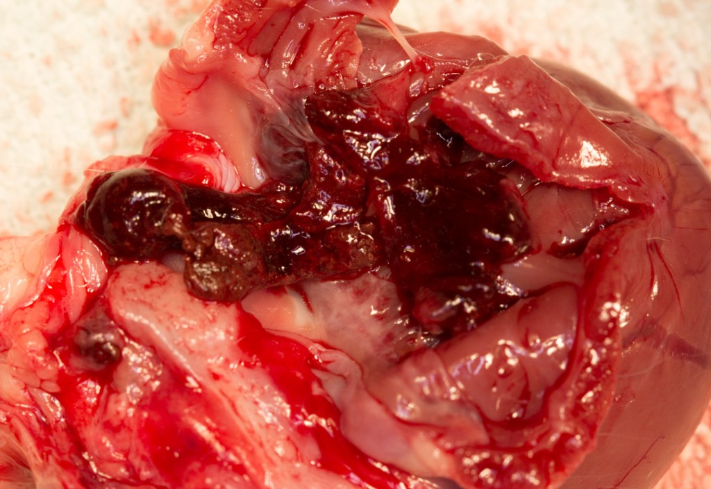 Heart with blood clot in chamber