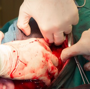 Starting the process of removing the spleen