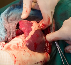 Spleen almost out of abdomen
