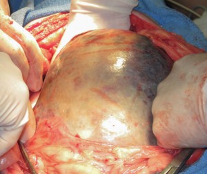 Attempting to remove large spleen from abdomen