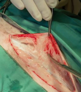 Dissecting tissue under skin