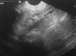 Ultrasound Picture of a Small Adrenal Gland