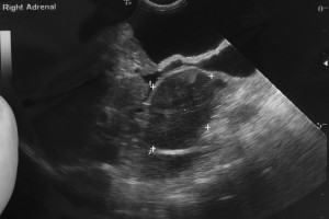 Ultrasound Picture of a Normal Adrenal Gland