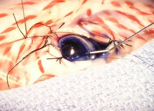Suctioning out any debris from the eye