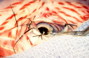 Increasing the size of the opening in the cornea