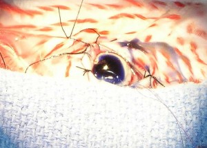 Suture the incision in the cornea