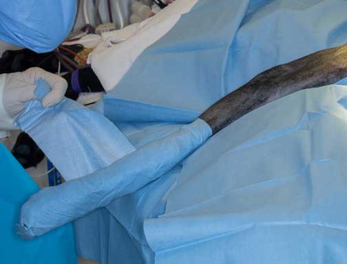 Final wrap of the foot with sterile tape