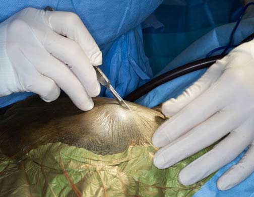 Making the skin incision with the scalpel