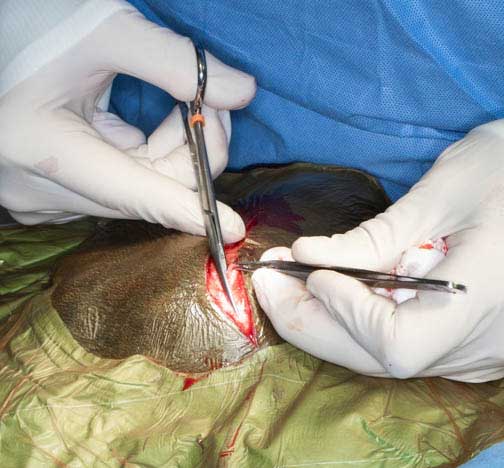 Cutting through the SQ layer under the skin