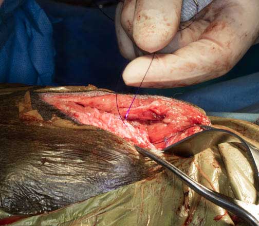Suturing tissue under the skin