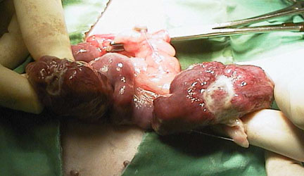 Cancerous uterus during surgery