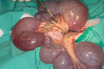 Uterus distended with fluid at surgery